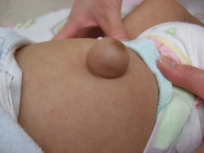 ヘルニア 赤ちゃん 臍 赤ちゃんの3つの臍トラブル〜臍ヘルニアや黒い！臭いがキツイ原因と2つの対処法